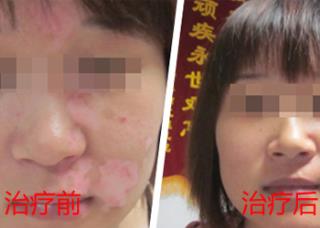 现石家庄什么格式可以治疗白癜风
