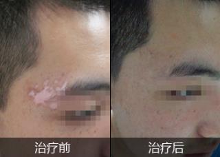石家庄治疗白斑好的白癜风病院