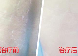 白癜风,女性白癜风,女性白癜风病因