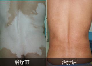 专家解说肢端型白癜风的治疗方法有哪些