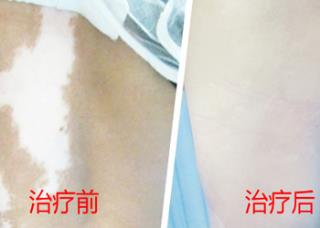 石家庄白癜风医院专家
