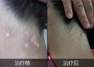 老年白斑怎样治疗