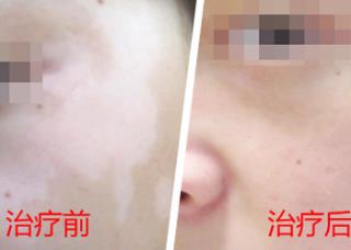 白癜风表现症状2岁宝宝得白癜风症状是什么