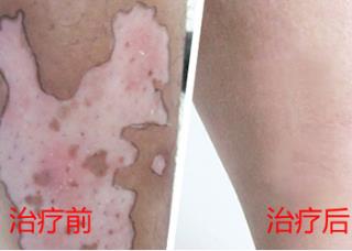 石家庄哪家病院可以治好白癜风