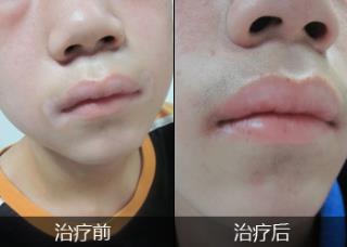 石家庄市哪家病院治疗看好白癜风下场好