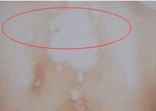 白癜风治疗时应遵守有的几项准绳