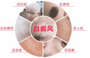 石家庄医师治疗白癜风