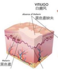 白癜风病的临床症状4个月的儿童白癜风的早期症状