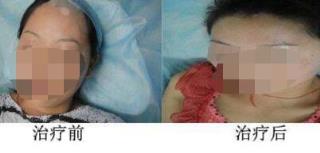 白癜风症状是什么