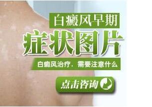 石家庄远大治疗白癜风比拟好医院