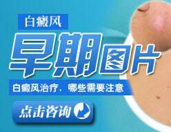 夏日白癜风高发时节,治疗白癜风要注重