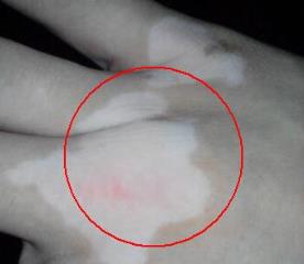 白癜风症状是不是不随便治啊
