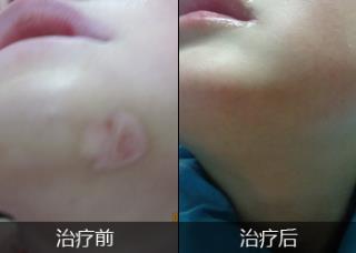 白癜风病发的缘由有哪些.