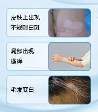 白癜风常识