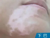 下巴白癜风案例图