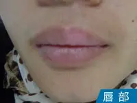 嘴唇唇部白癜风案例图