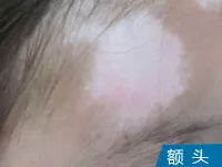 额头白癜风案例图