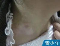 青少年颈部白癜风案例图