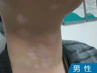 男性颈部白癜风案例图