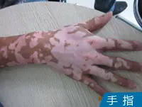 手背白癜风案例图