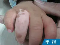 手指白癜风案例图