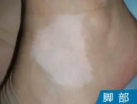 脚背白癜风案例图