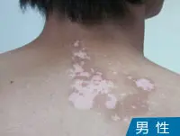 青少年背部白癜风案例图