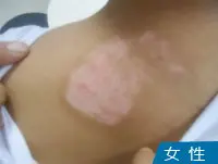 男性背部白癜风案例图