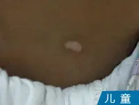 儿童白癜风病例
