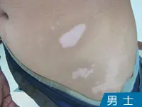 男性白癜风病例
